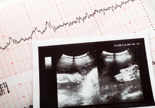 A fetal echocardiogram (also called a fetal echo) uses sound waves to create pictures of an unborn baby's heart. This painless ultrasound test shows the structure of the heart and how well it's working - October 19 2022