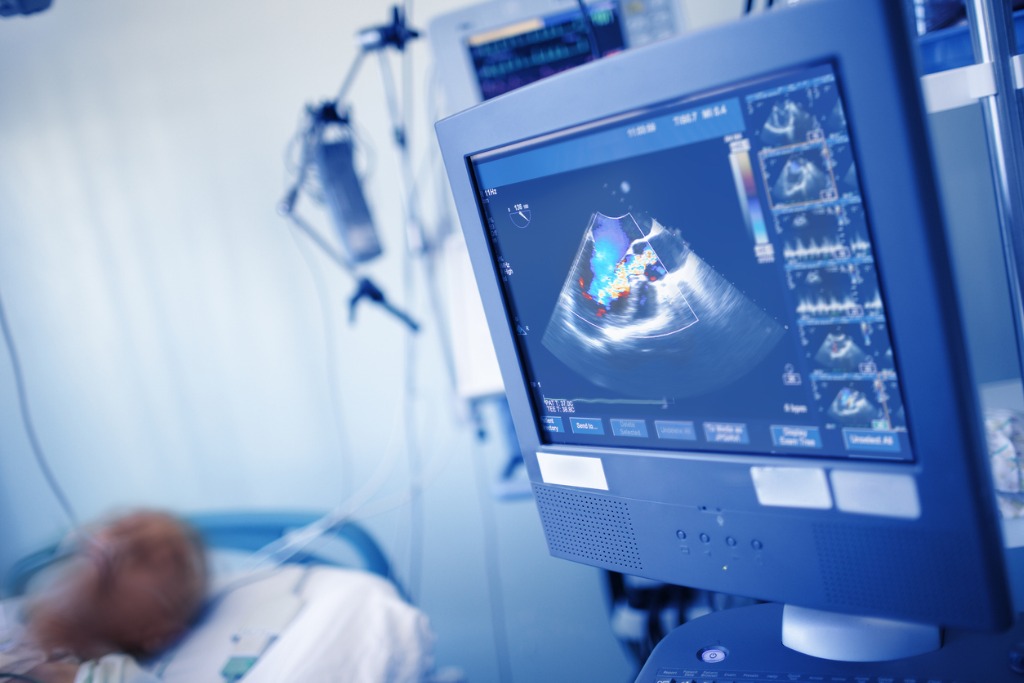 An echocardiogram is a test of the action of the heart using ultrasound waves to produce a visual display, used for the diagnosis or monitoring of heart disease.