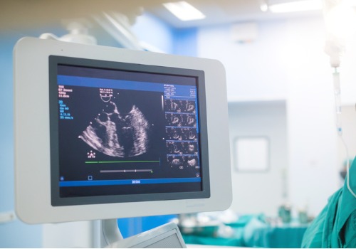 An echocardiogram, unlike an ECG, provides a detailed image of the heart muscle and heart valves - October 19 2022 - National Diagnostic Imaging Teleradiology Company - Cleveland Ohio