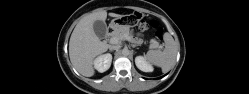 CT SCAN of Thorax and Abdomen (Computed Tomography- CAT) - National Diagnostic Imaging October 25 2022 - Cleveland Ohio