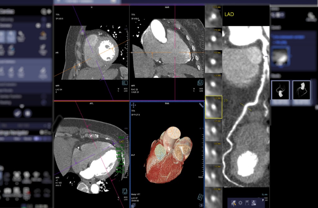 CT coronary angiography is increasingly used to detect coronary artery disease in patients with an intermediate risk and in those with equivocal stress test results.