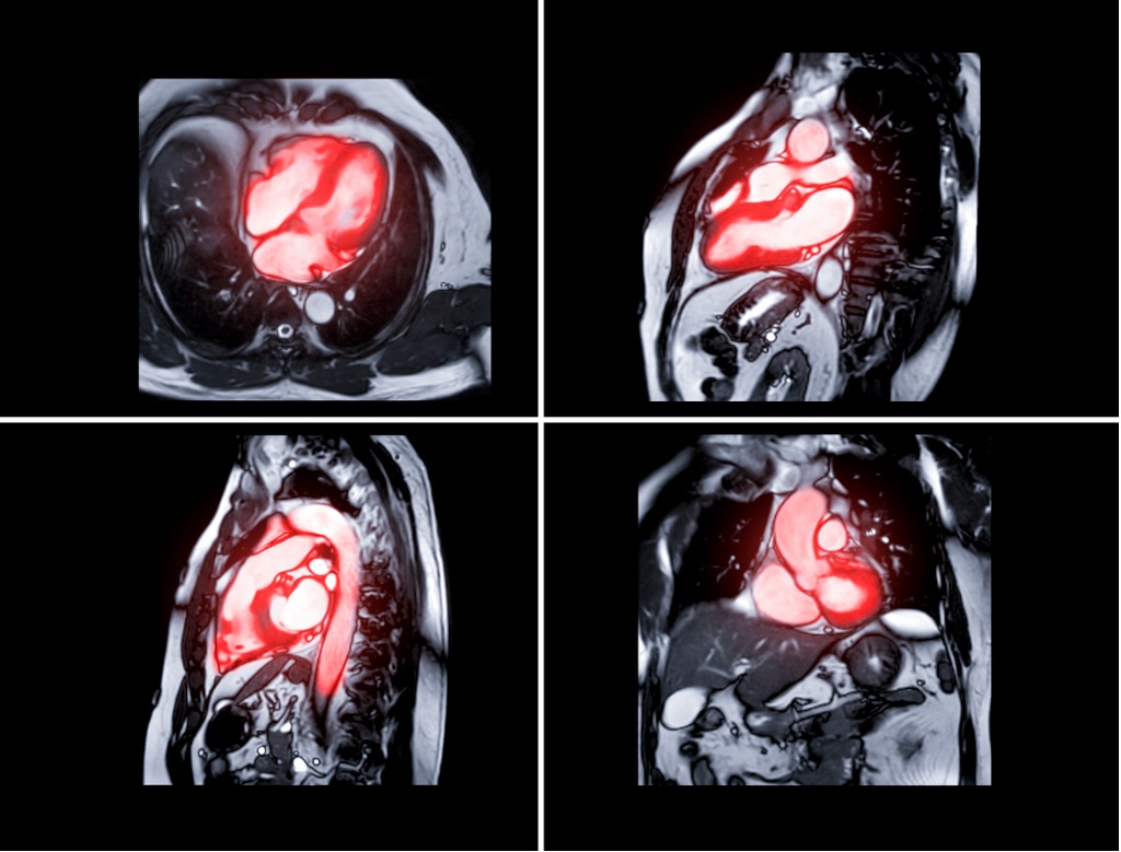 Cardiac magnetic resonance imaging (cardiac MRI or CMR) produces detailed images of the beating heart - December 8 2022 - NDI