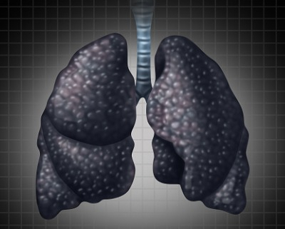 Coal workers' pneumoconiosis (CWP), commonly known as black lung disease, occurs when coal dust is inhaled.