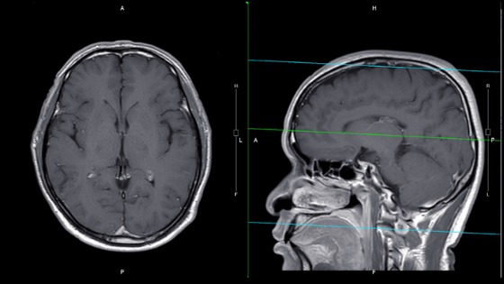 NDI neuroradiologists interpret magnetic resonance images (MRI) scans of the brain. They use MRIs to analyze the anatomy of the brain and to identify some pathological conditions such as cerebrovascular incidents, demyelinating and neurodegenerative diseases.