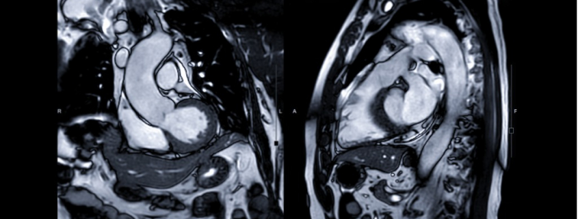 NDI vascular radiologists perform remote off-site cardiac (heart) magnetic resonance imaging interpretation and reporting services for diagnostic imaging centers in all 50 states. MRI reading services provided by NDI help physicians diagnose medical conditions such as tissue damage caused by a heart attack.